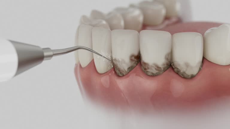 Trusted Dental Implants service in Marysville, OH - Dentist Open Now